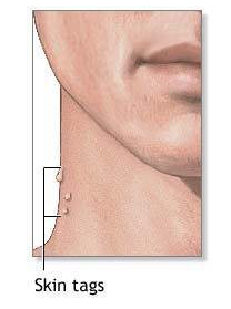 papilloma colli on neck